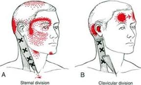 BLOG 1 PUNCIÓN SECA Y PUNTOS GATILLO. SU EVOLUCIÓN A LO LARGO DE MÁS DE 50 AÑOS.