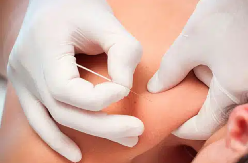 JFK, Wimbledon y el mito de la aguja: ¿Realmente compensa la punción seca?